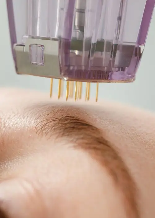 Microneedling device creating controlled microchannels in facial skin